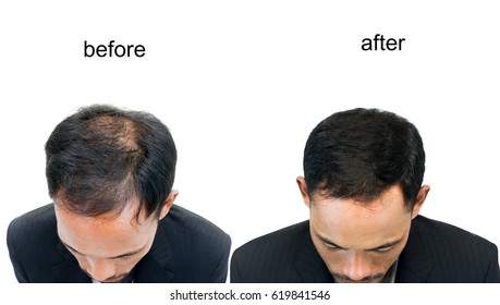  Before And After Bald Head Of A Man On White Background.