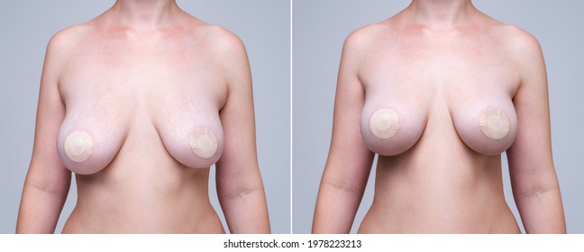 Before and after breast augmentation concept, woman with large silicone breasts after correction surgery on gray background
