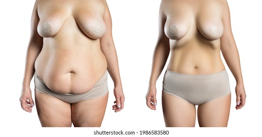 Before and after breast augmentation concept, woman with large silicone breasts after correction surgery and liposuction isolated on white background