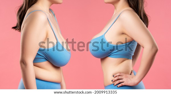 Before and after breast augmentation concept,\
woman with very large silicone breasts after correction surgery on\
pink background