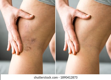Before After Cellulite Inflammation Legs Treatment Closeup