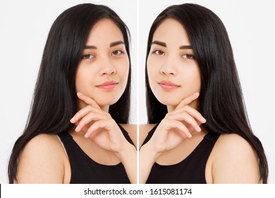 Before After Close Up Asian Woman Face With Dark Circles Under Eyes And Problem Skin. Beauty Skin Care Treatment. Before-after Facial Problems. Dermatology Cosmetology Changing Procedures.