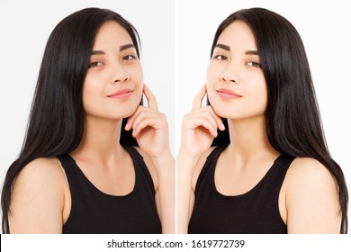 Before After Close Up Asian Woman Face With Dark Circles Under Eyes And Problem Skin. Beauty Skin Care Treatment. Before-after Facial Problems. Dermatology Cosmetology Changing Procedures.