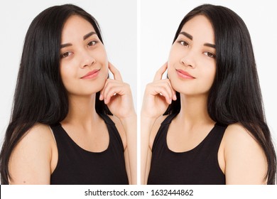 Before After Close Up Asian Woman Face With Dark Circles Under Eyes And Problem Skin. Beauty Skin Care Treatment. Before-after Facial Problems. Dermatology Cosmetology Changing Procedures.