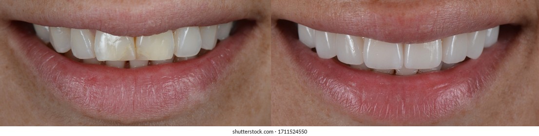 Before And After Of Close Up Smile Of Smile Makeover With Dental Veneer Treatment.