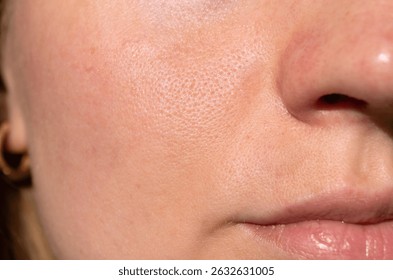 Before and after close-up showing improved facial skin texture and reduced acne, highlighting skincare results and pore clarity in natural lighting.