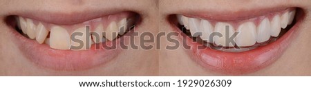 Before and after comparing of dental ceramic veneers treatment for space closing.