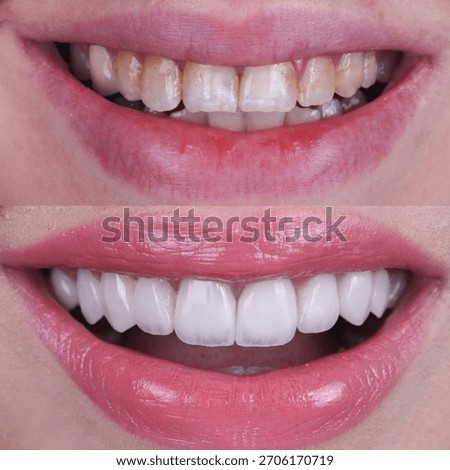 Before and after comparison of a young woman’s teeth showing whitening and veneers transformation