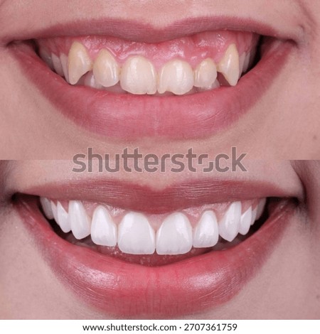 Before and after comparison of a young woman’s teeth showing whitening and veneers transformation