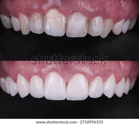 Before and after comparison of a young woman’s teeth showing whitening and veneers transformation