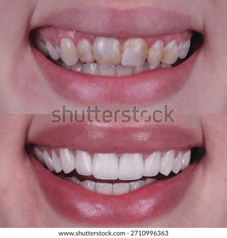 Before and after comparison of a young woman’s teeth showing whitening and veneers transformation
