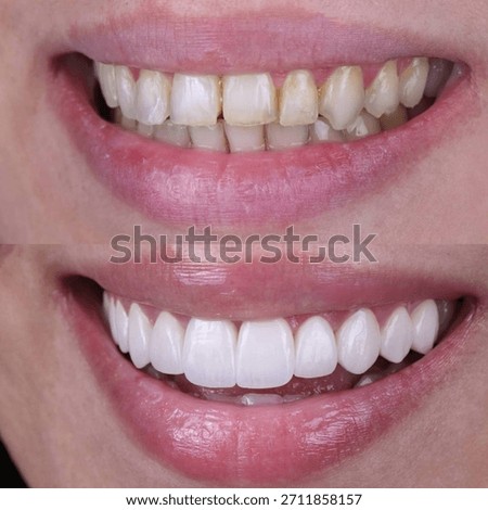 Before and after comparison of a young woman’s teeth showing whitening and veneers transformation