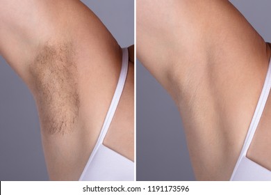 Before After Waxing Images Stock Photos Vectors Shutterstock