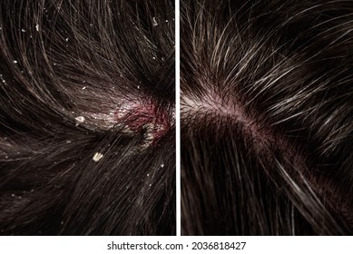 Before And After Dandruff Treatment Shampoo On Hair Woman. Dandruff In The Hair. Flaky Scalp. Seborrhea. 