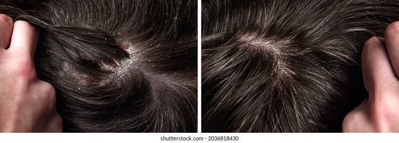 Before and after dandruff treatment shampoo on hair woman. Dandruff in the hair. Flaky scalp. Seborrhea.  - Shutterstock ID 2036818430