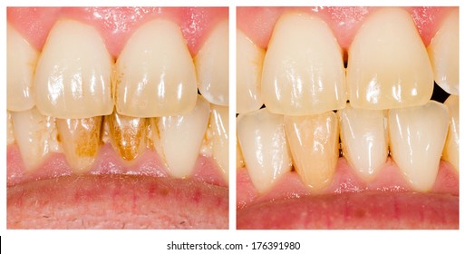 Before And After Dental Plaque Removal Treatment.