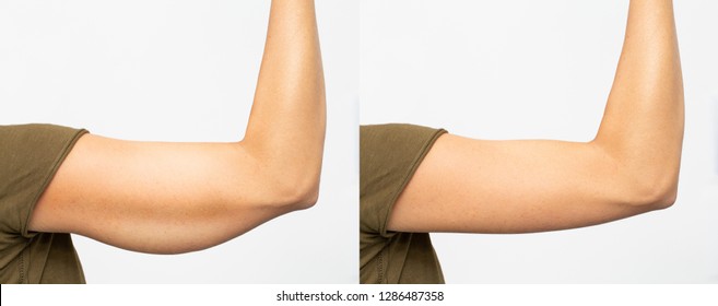 Before and after excess skin removal under the arm