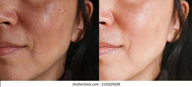 Before And After Facial Treatment Concept. Face With Melasma And Brown Spots And Open Pores. 