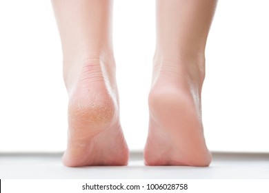 Before after feet care concept, female foot, chiropody isolated on white background, studio shot