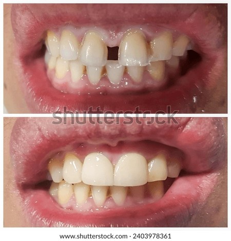 Before and after fixation for huge gap between the front teeth or incisors, diastema.