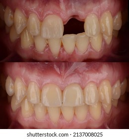 Before And After Of Fixed Type Denture On Dental Implant In The Front Teeth.