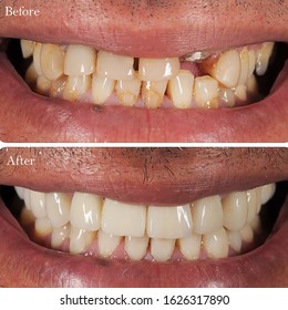 Before and after fixing new teeth for the patient 