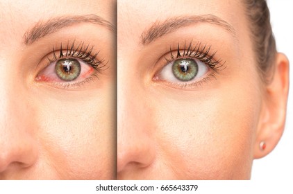 Before And After A Glaucoma, Red Eye With And Without Medical Treatment