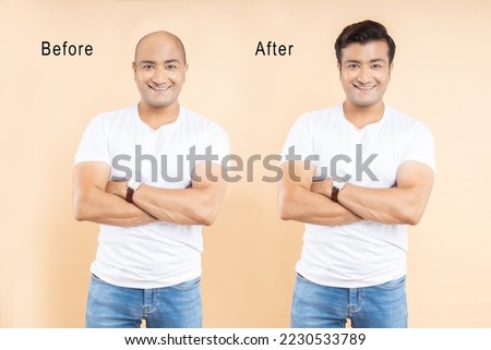 Before and After of hair loss treatment or transplant of a young indian man isolated on beige background.