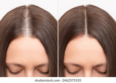 Before and after head shot of a young woman with a receding hairline on her forehead and parting. Baldness. Close-up, front view. Hair care and treatment concept. Hair loss, hair transplant, alopecia