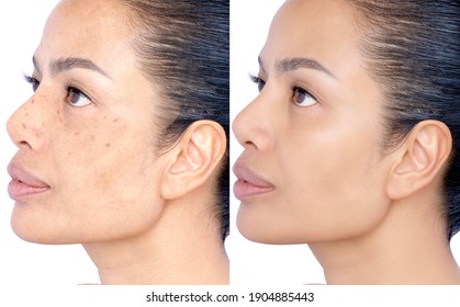 Before And After Healing Removing Problem Of Facial Wrinkles, Melasma, Dark Spots, Freckles, Dry Skin On Middle Age Woman Face Skin Care And Cosmetology Concept. Studio Headshot Isolated On White.