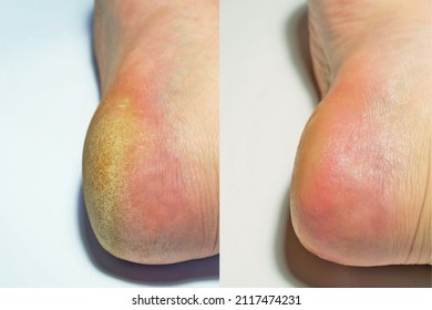 before and after image showing a dry dehydrated heel and soft heel skin after treatment, the concept of feet care and health, comparison