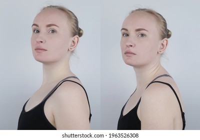 Before After Kyphosis Woman Suffers Curvature Stock Photo 1963526302 ...