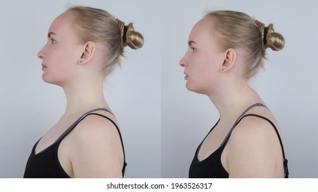 Vor und nach der Kyphose. Die Frau leidet an einer Wirbelsäulenkrümmung im oberen Bereich. Die Halswirbel zaudern aus und bilden einen Höcker. Krümmungskonzept und unrichtiges Haltungskonzept