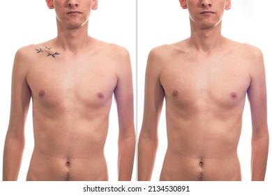 Before And After Laser Tattoo Removal On A Man.