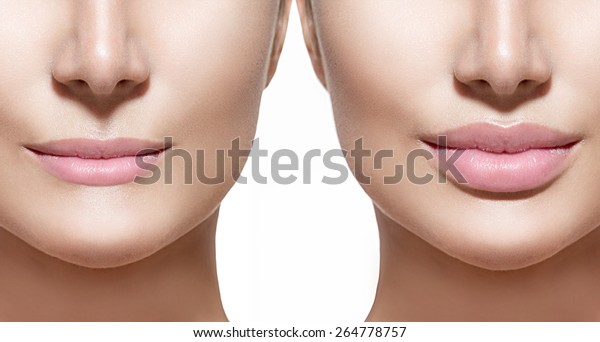 口唇充填剤注入の前後 フィラー 唇の増強美しい完全な唇 セクシーな口の接写 美人の若い女性は口を開く 白い背景に接写 の写真素材 今すぐ編集