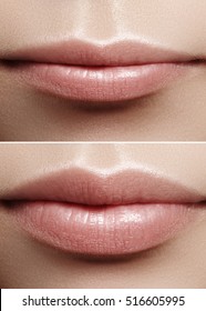Before and after lips filler injections. Beauty plastic. Beautiful perfect lips with natural makeup. Sexy macro with female mouth.Plump lips augmentation. Salon procedure