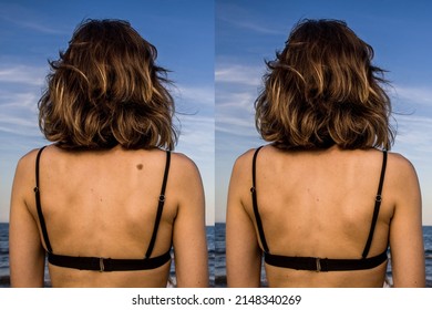 Before And After Melanoma Mole Operation On The Back Of A Woman In A Black Bikini On The Beach. Skin Surgery Concept.