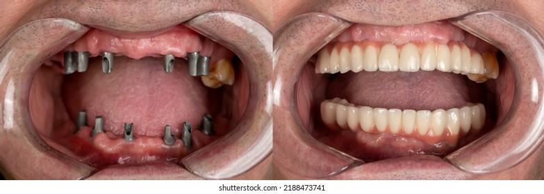 before and after pictures of dental implants and press ceramic crowns - Shutterstock ID 2188473741