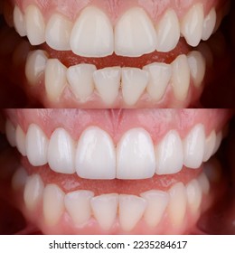 Before and after of porcelain laminated veneers on top front teeth. - Shutterstock ID 2235284617