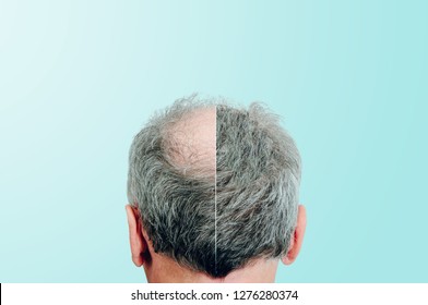 Before and after, Rear view of a male head without hair. Hair loss concept, bird's nest on the head. Problems with hair regrowth, shampoo for facial hair growth. - Powered by Shutterstock