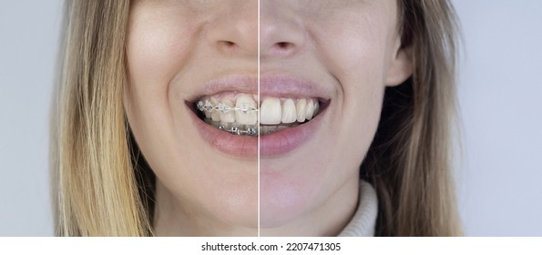 Before and after remove braces. On left is a girl in a metal bracket system, and on right are straight teeth after the procedure. Concept of correcting a smile and straightening teeth. Close-up - Shutterstock ID 2207471305