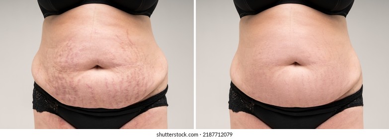 Before and after removing stretch marks from the skin, fat flabby female belly on gray background, skin care concept - Shutterstock ID 2187712079