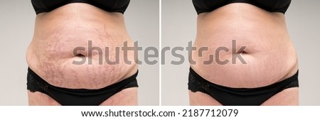 Before and after removing stretch marks from the skin, fat flabby female belly on gray background, skin care concept