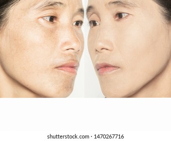 Before And After Retouch Face And Make Up  Woman  And Skin Problems  Facial Treatment Step