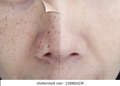 Before and After Retouch Freckles on Young Asian Woman Face - Shutterstock ID 1100826239