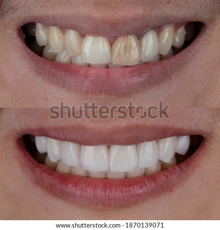 Before and after shot of smile makeover by dental ceramic veneer, porcelain laminated veneers.