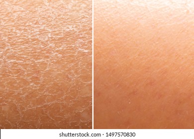Before and after skin moisturization is seen in detail, with dried and cracked skin against a flawless smooth complexion. - Shutterstock ID 1497570830