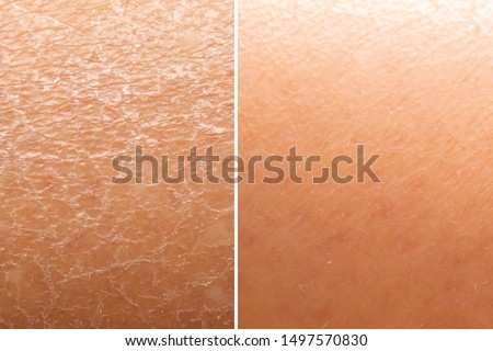 Before and after skin moisturization is seen in detail, with dried and cracked skin against a flawless smooth complexion.