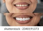 before and after smile design on a beautiful woman in high resolution