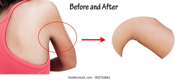 Before After Stretch Mark Wrinkle Armpit 303716864 Shutterstock before-after-stretch-mark-wrinkle-armpit-303716864-shutterstock